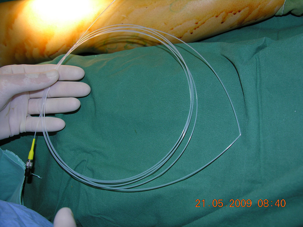varicoza anestezie epidurala)